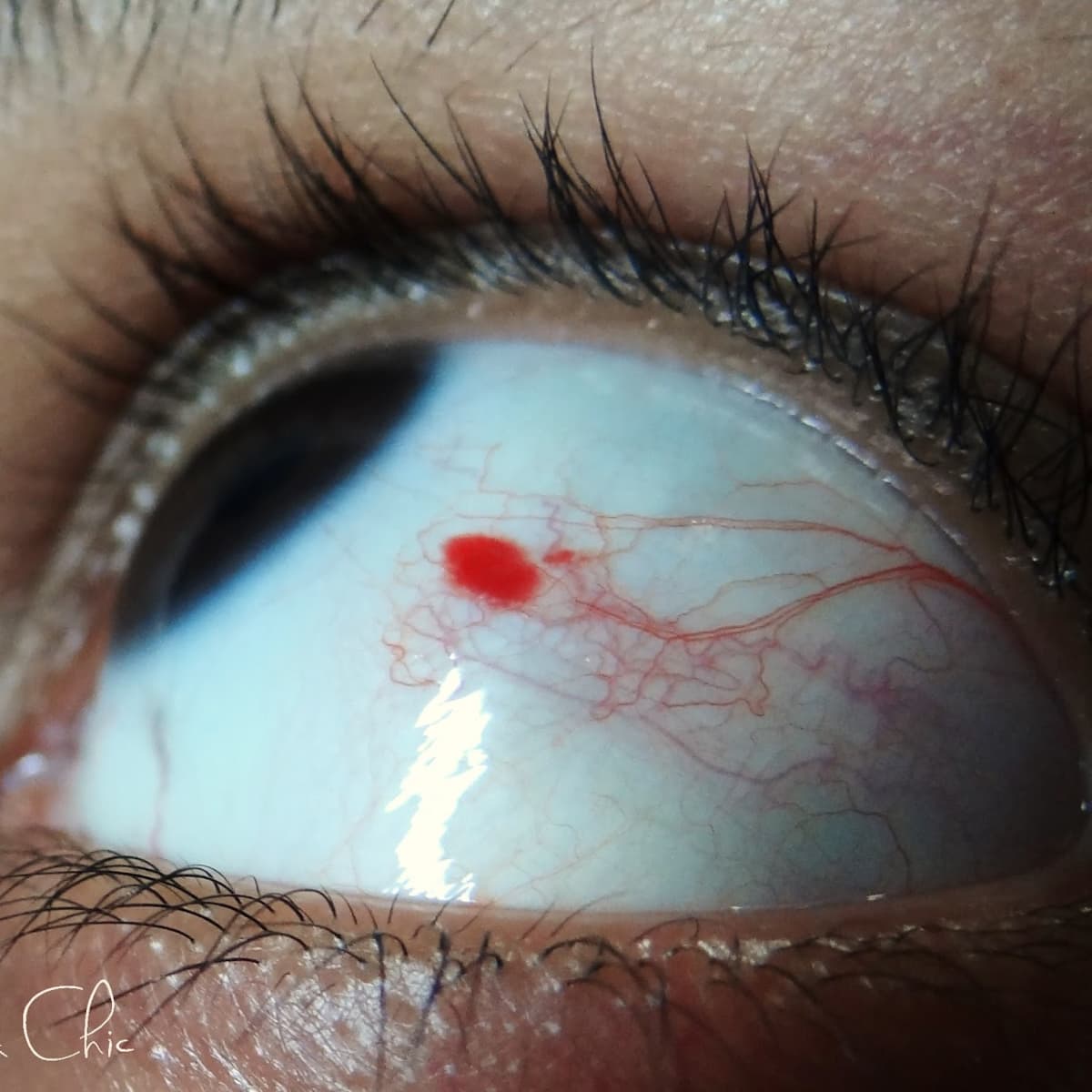 Causes of a Spot Eye - YouMeMindBody