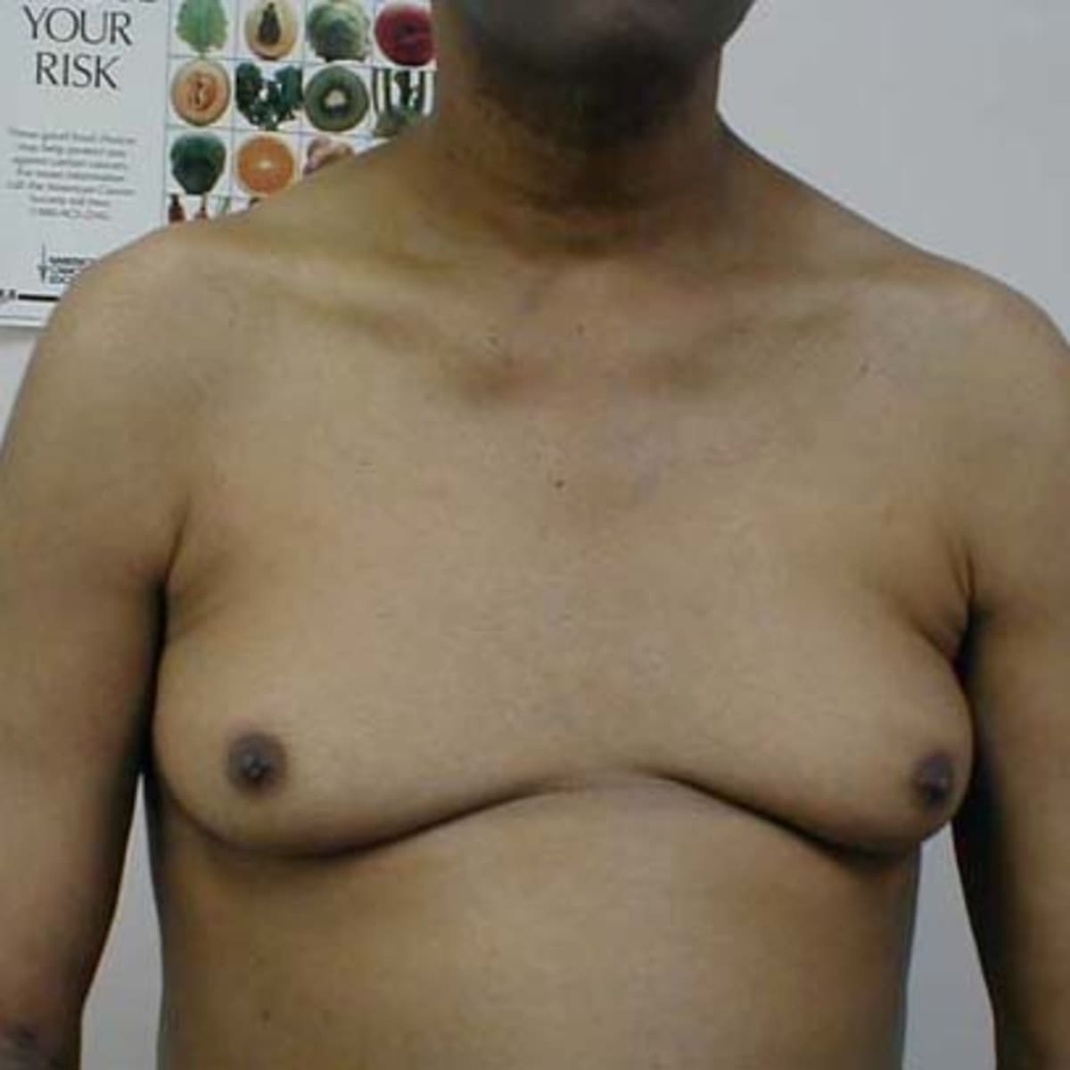 Man grew 38C breasts as a teenager - and now lives as a woman