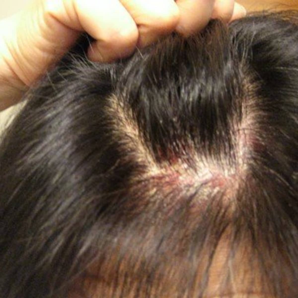 Itchy Scalp Causes and Treatments