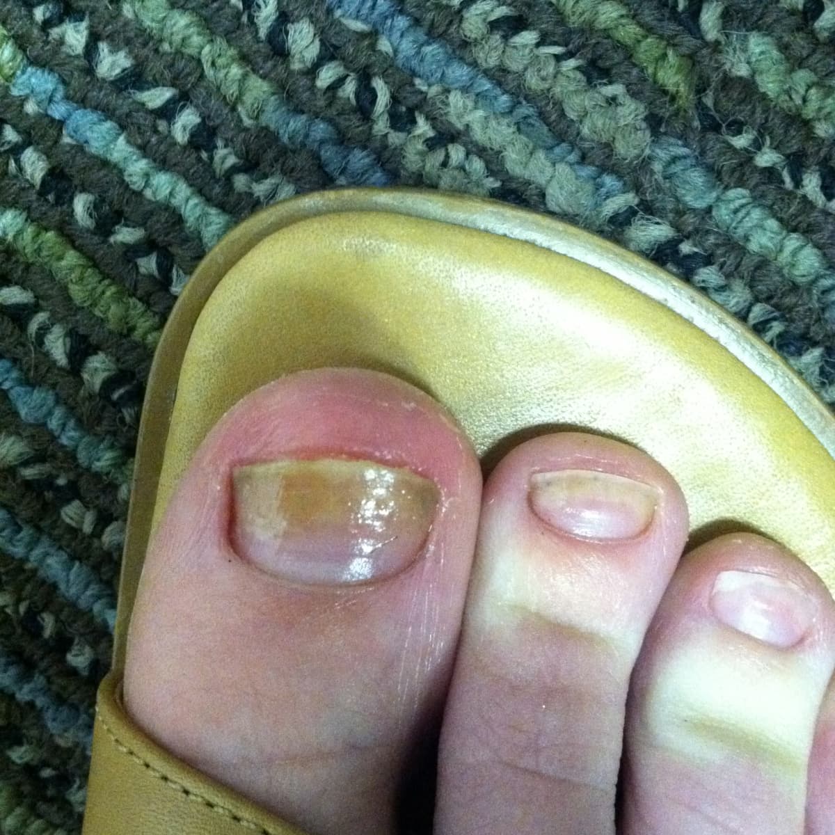 When is it time to visit a foot and ankle doctor for toenail fungus?