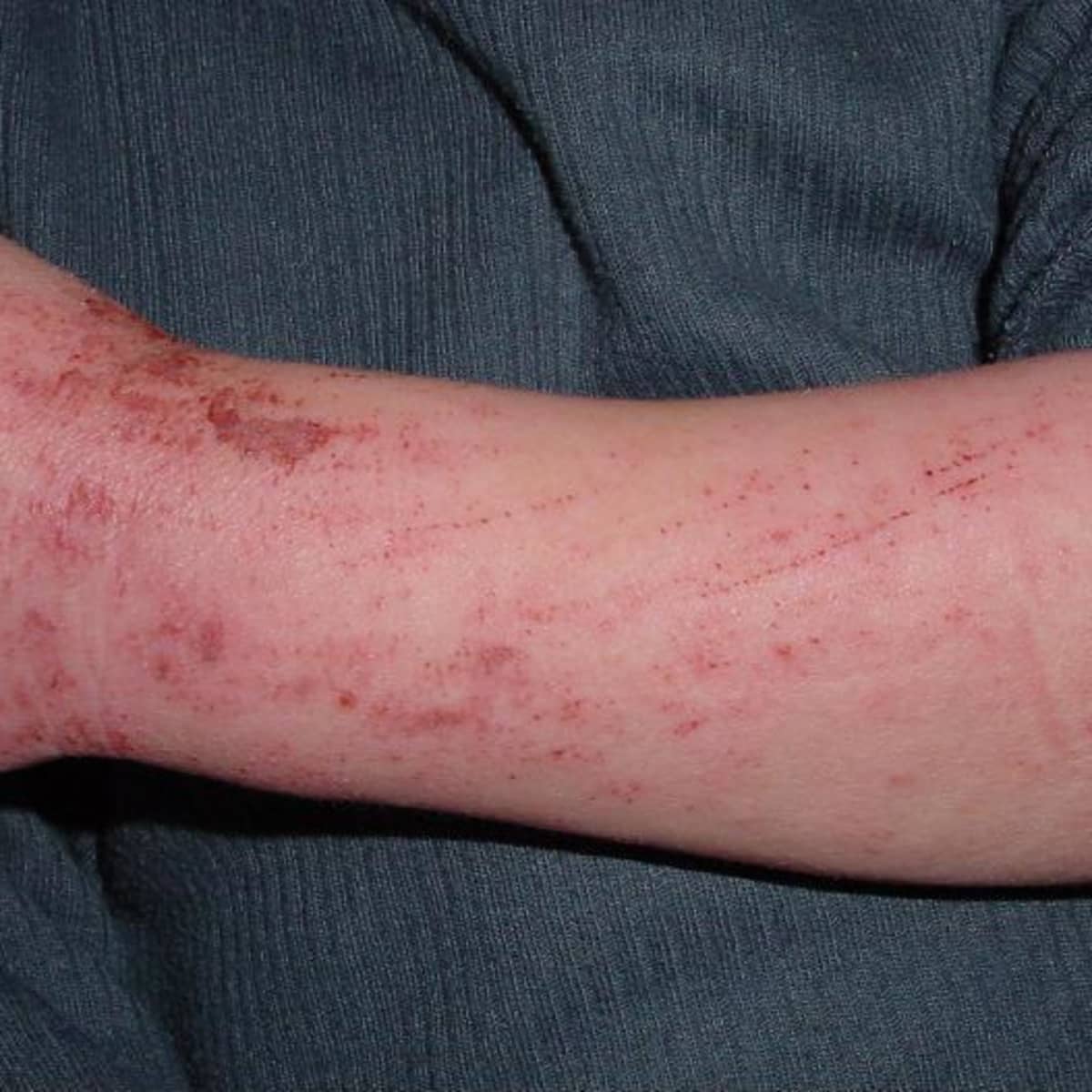 Eczema-symptoms, causes and coping:my husband's experience - HubPages