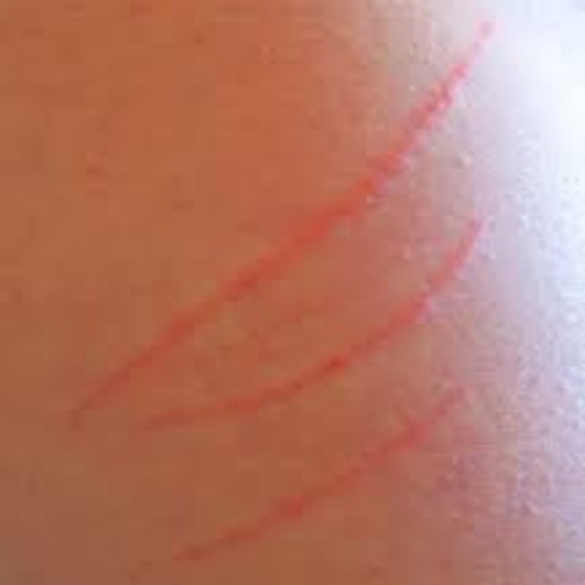 Mysterious Demonic Scratches Explained- What do these scratches on my body  mean? (With Photos and Video) - HubPages