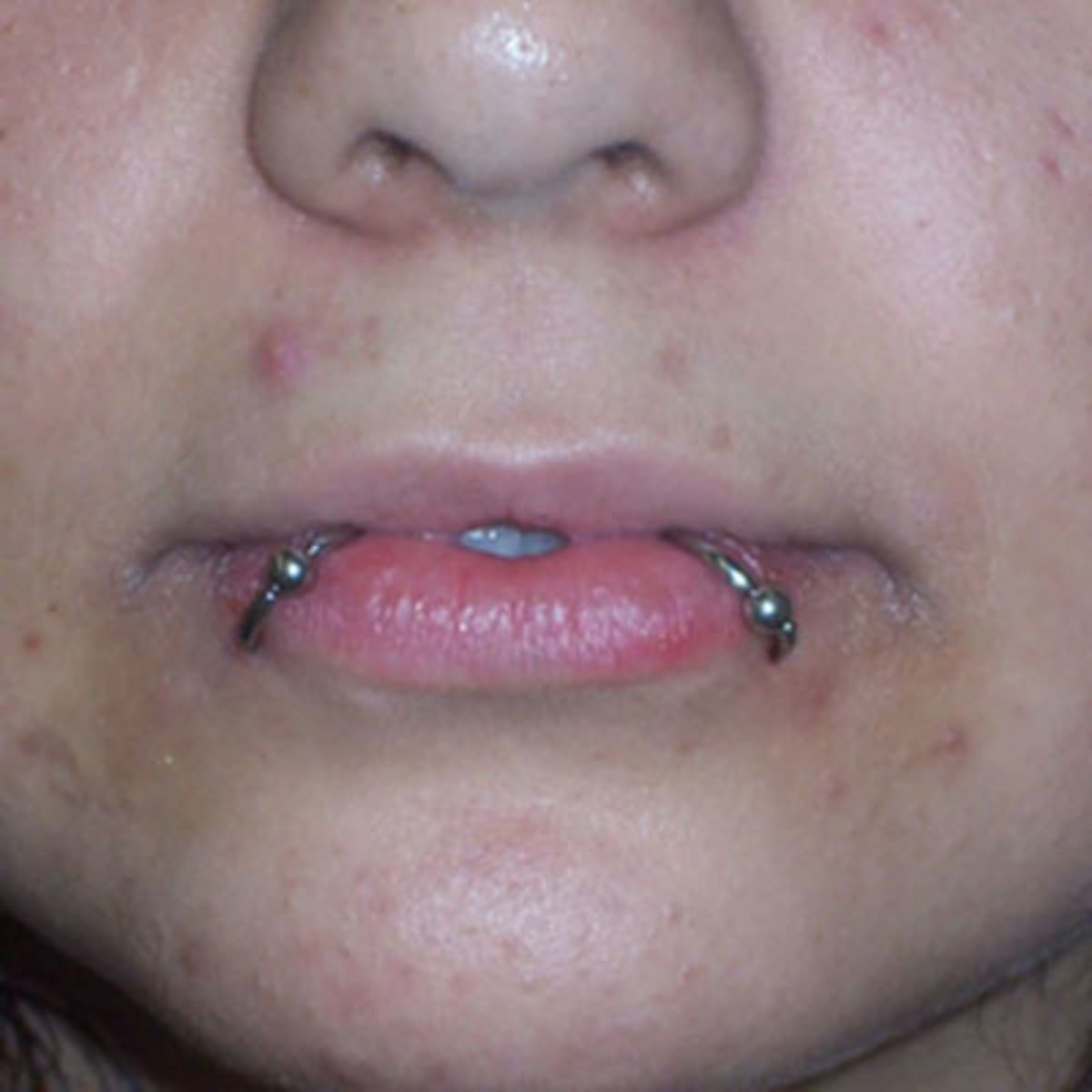 lip ring scar tissue build up