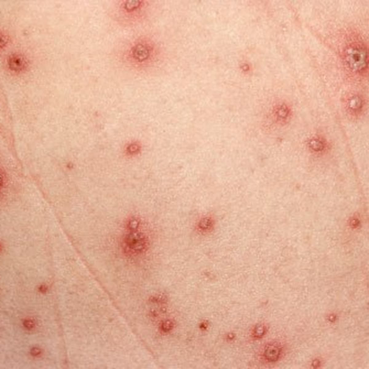 Messing Forkæl dig Vanding Red Spots on Skin - HubPages