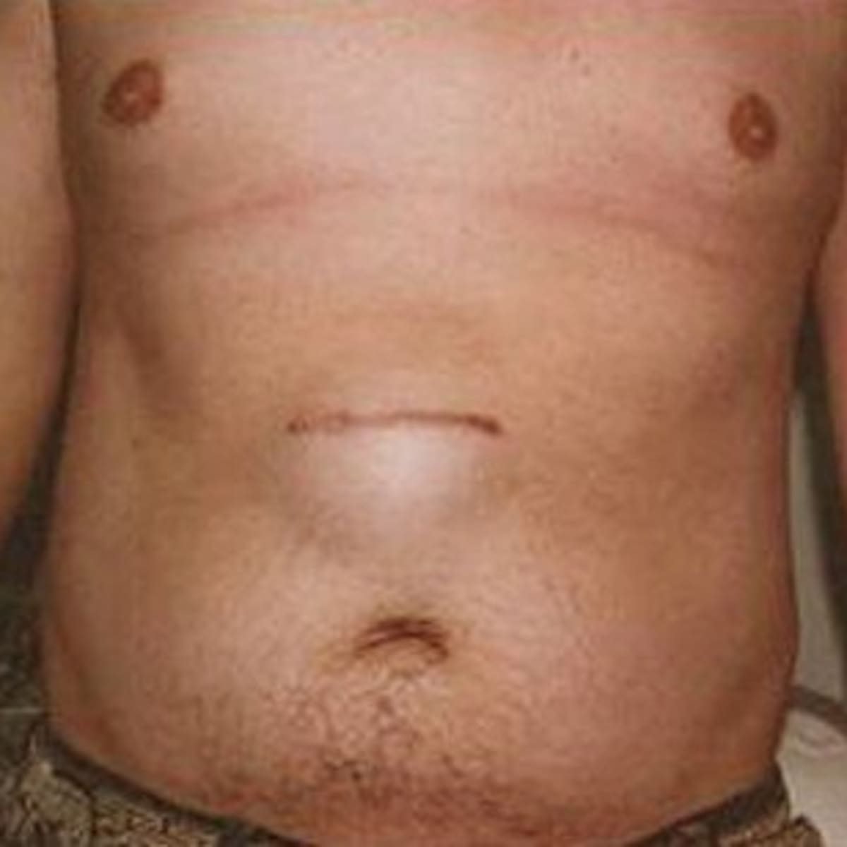 Pictures, Symptoms, Treatment & Causes of Epigastric Hernia - HubPages