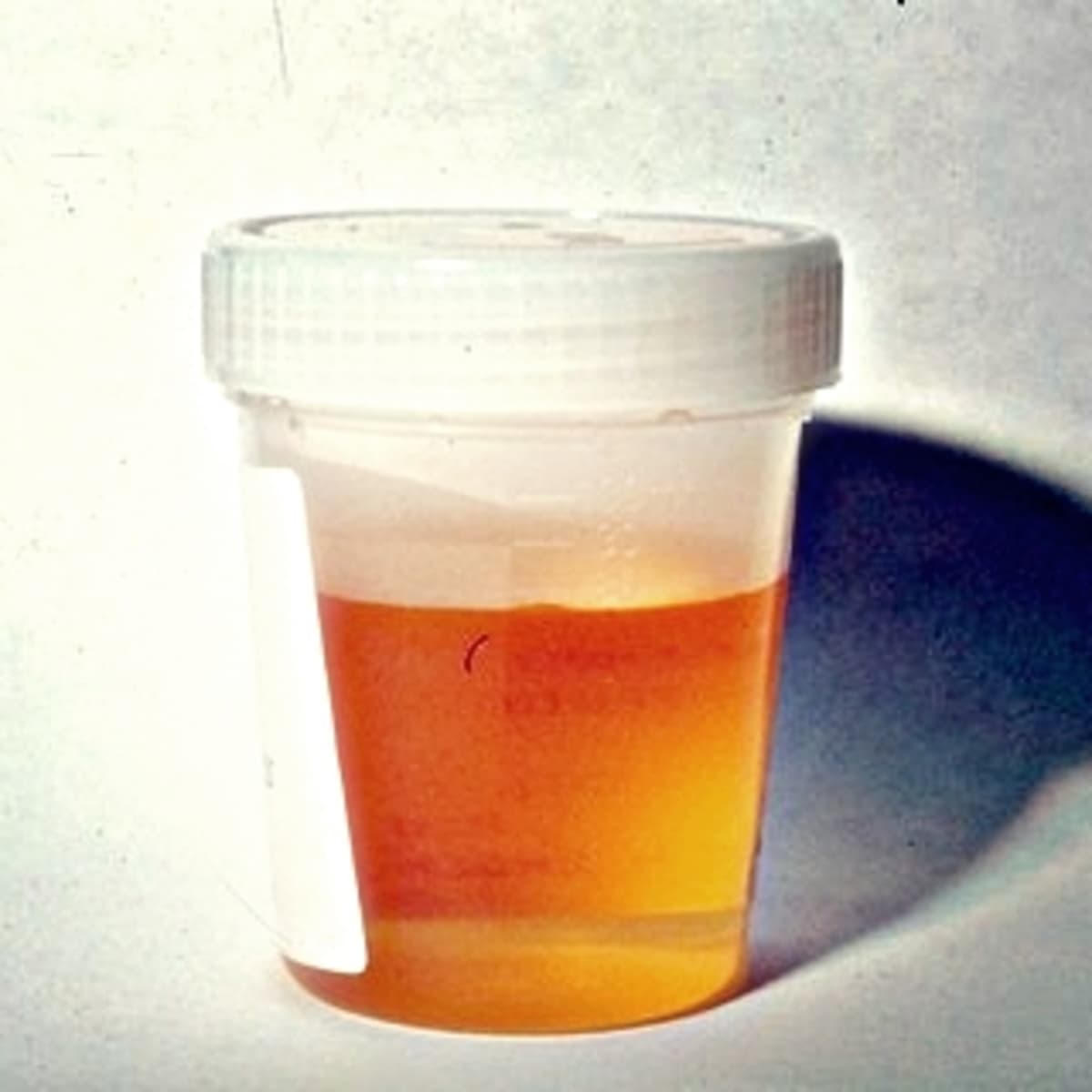 Orange Urine – Causes, Symptoms, Diagnosis,Treatment - HubPages