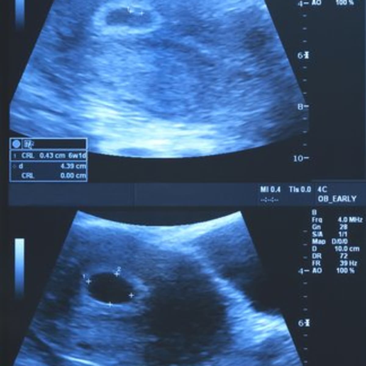 Sac empty tilted ultrasound uterus Tilted Uterus:
