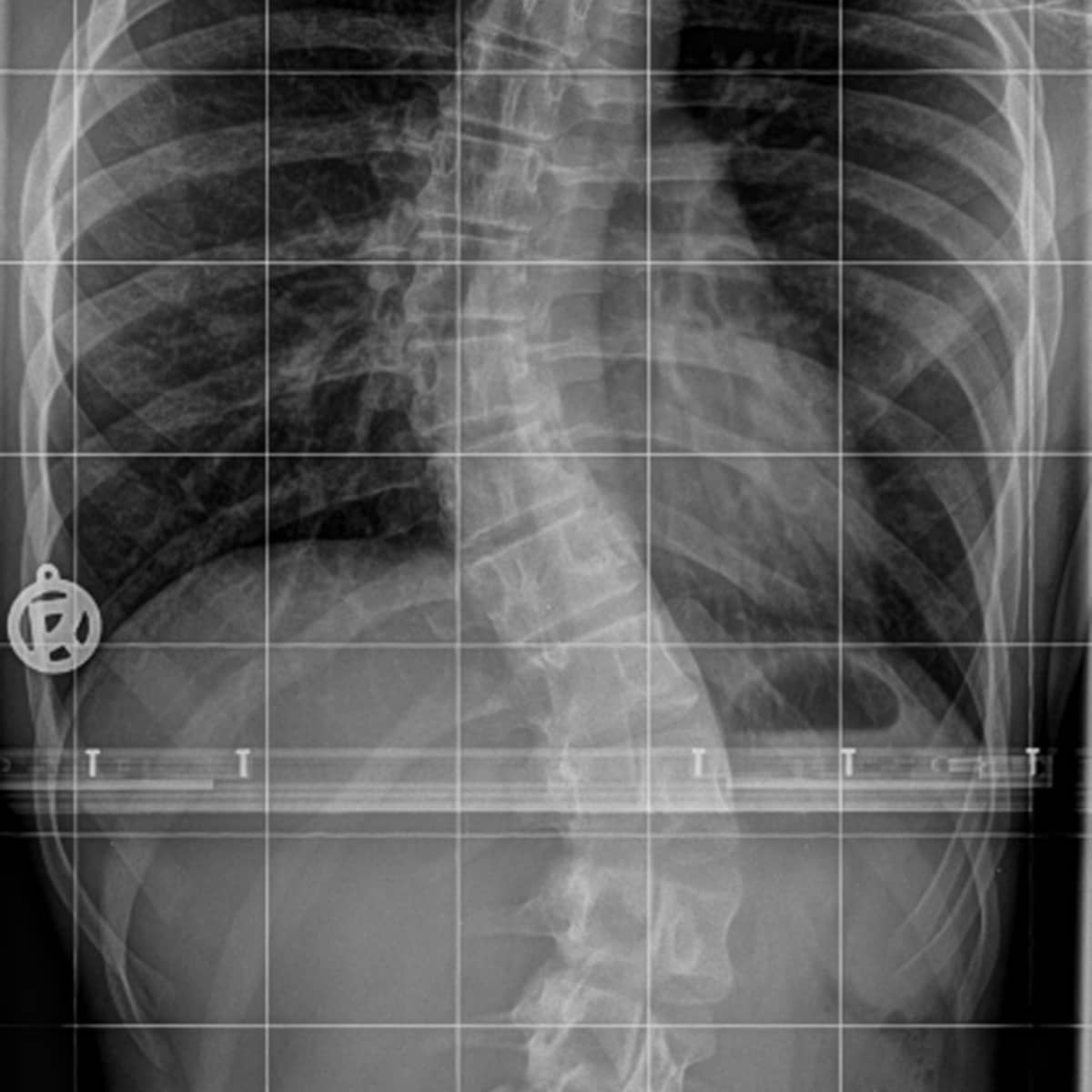 Pillow of Scoliosis of the spine, X-ray C016 / 6566