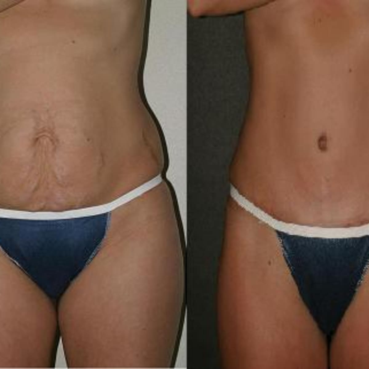 Are You a Good Candidate for a Mini Tummy Tuck?