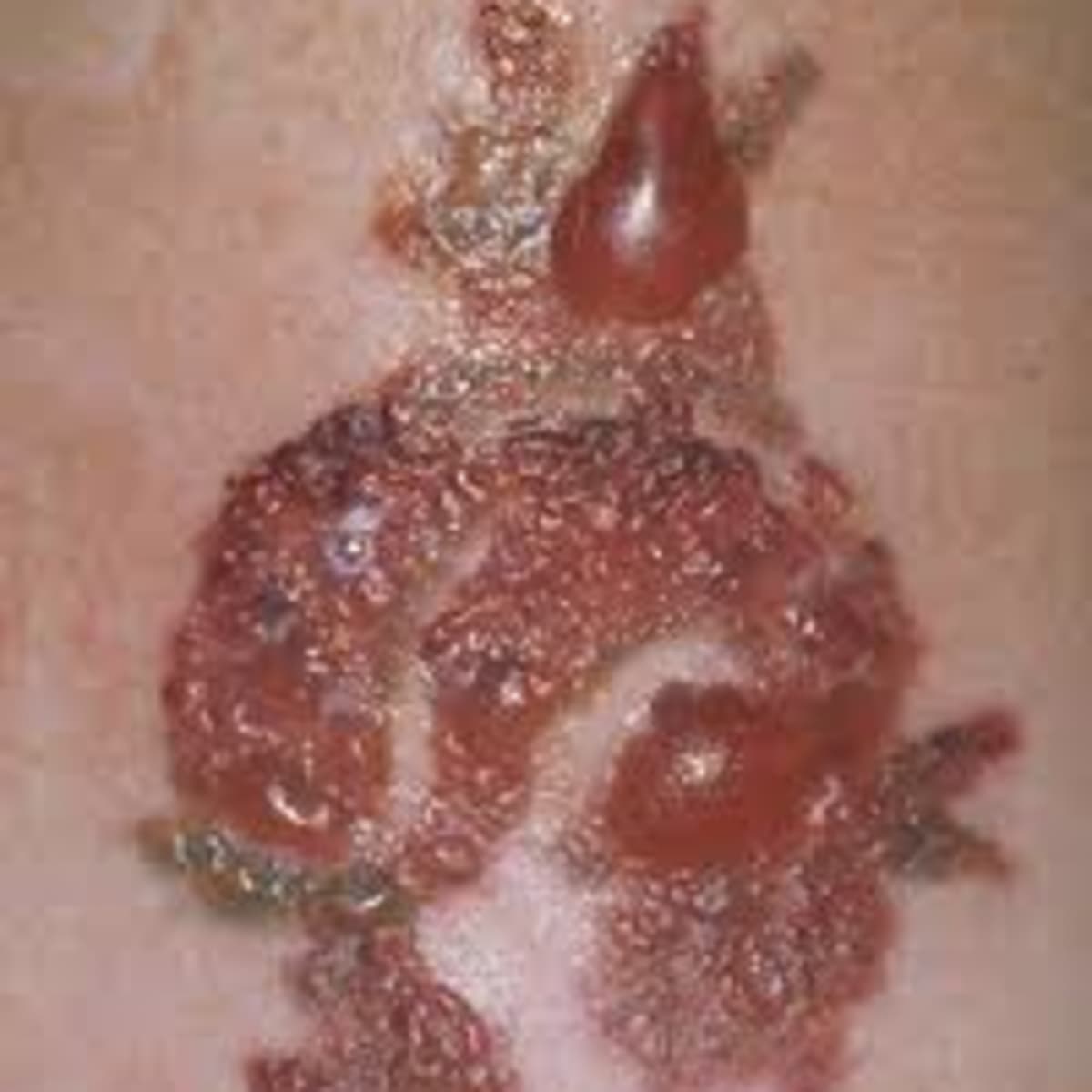How to Treat a Tattoo Infection - HubPages
