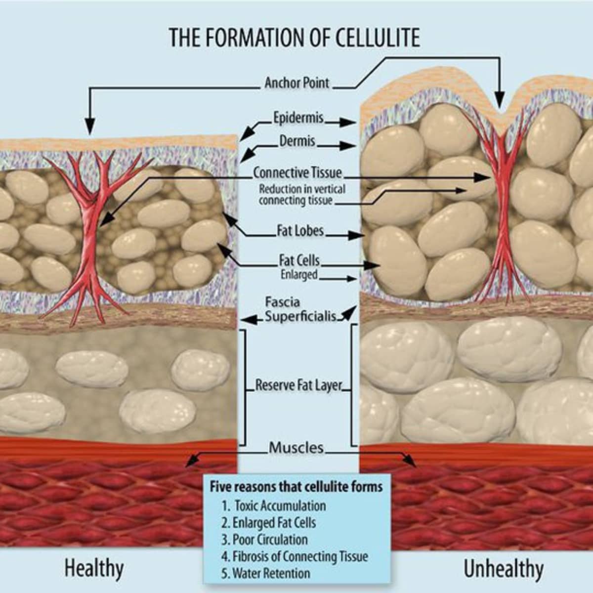 7 ways to reduce cellulite quickly and easily - abloomnova
