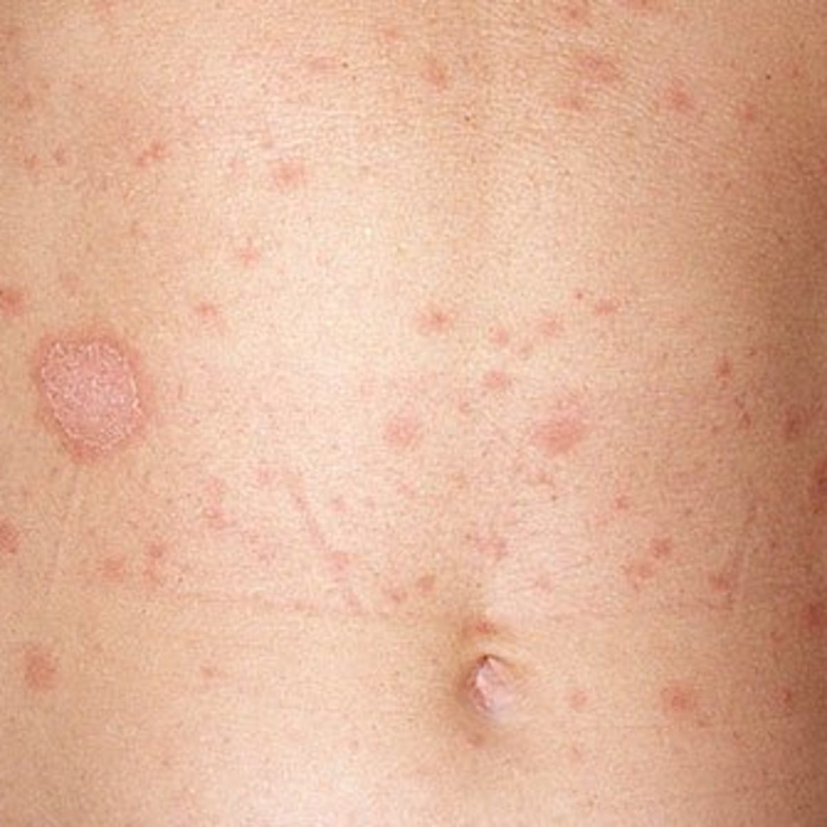 Pityriasis Rosea My Strange Full Body Rash Youmemindbody