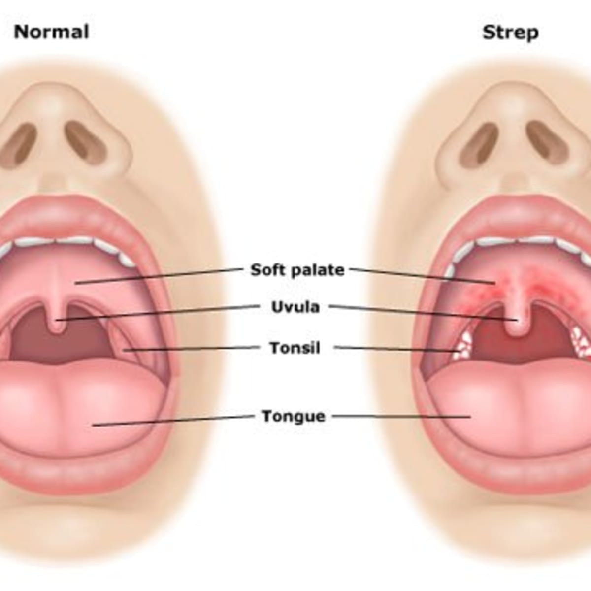 Home Remedies For Sore Throat Relief Remedygrove Holistic Wellness