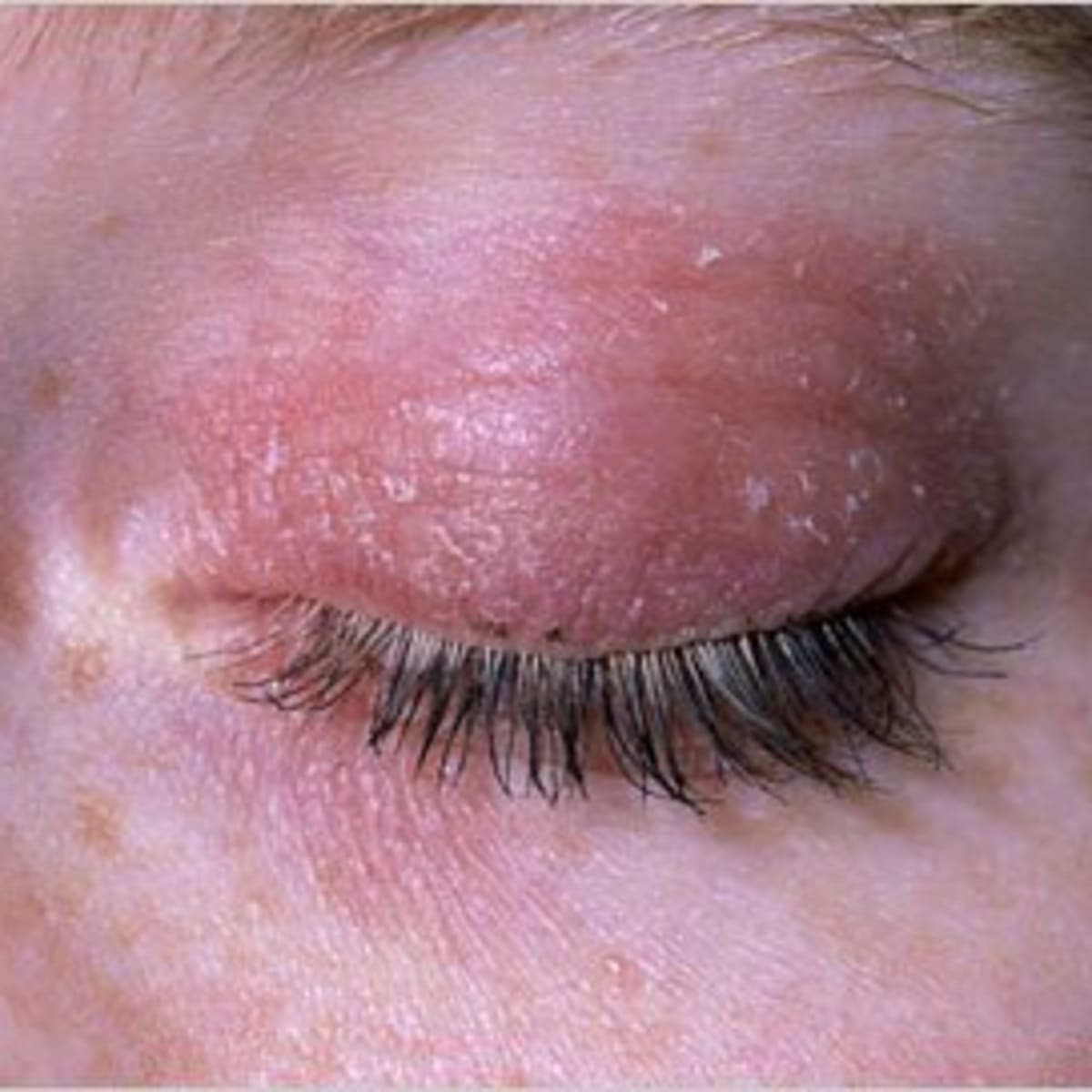 How To Get Rid Of Dry Red Skin On Eyelids Hubpages rid of dry red skin on eyelids