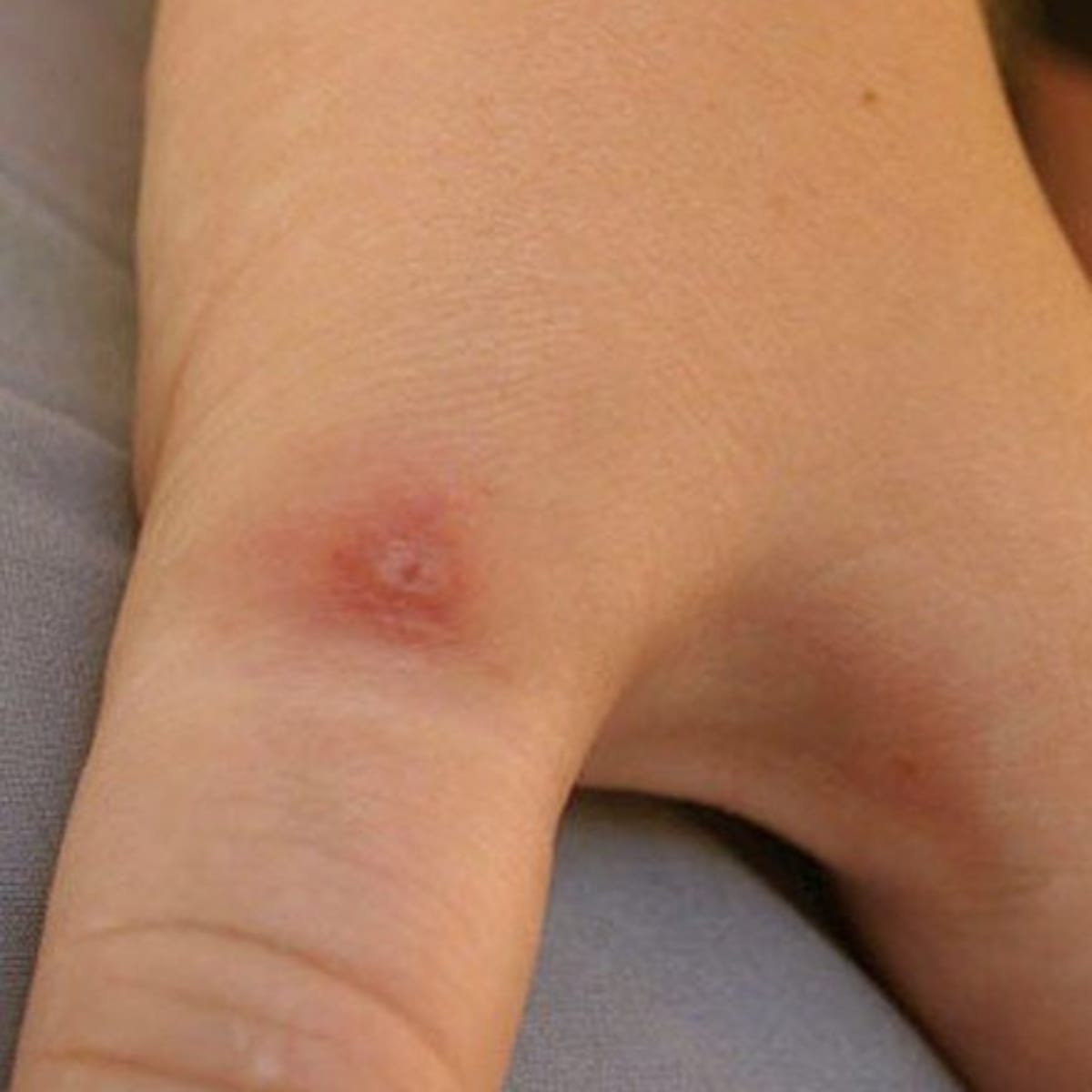 Pictures Symptoms And Treatment Of Black Widow Spider Bites Hubpages