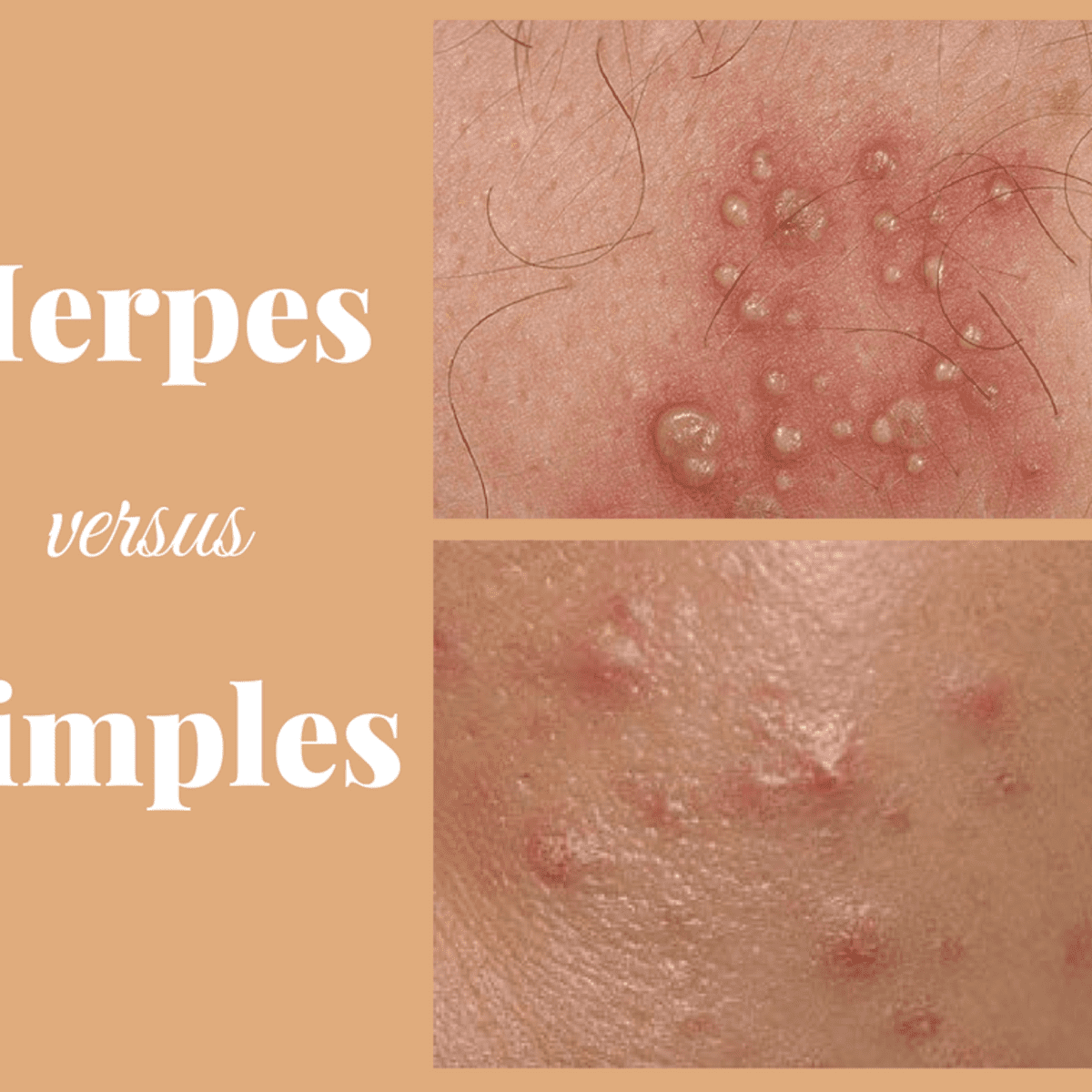 Herpes bumps vs Ingrown Hair
