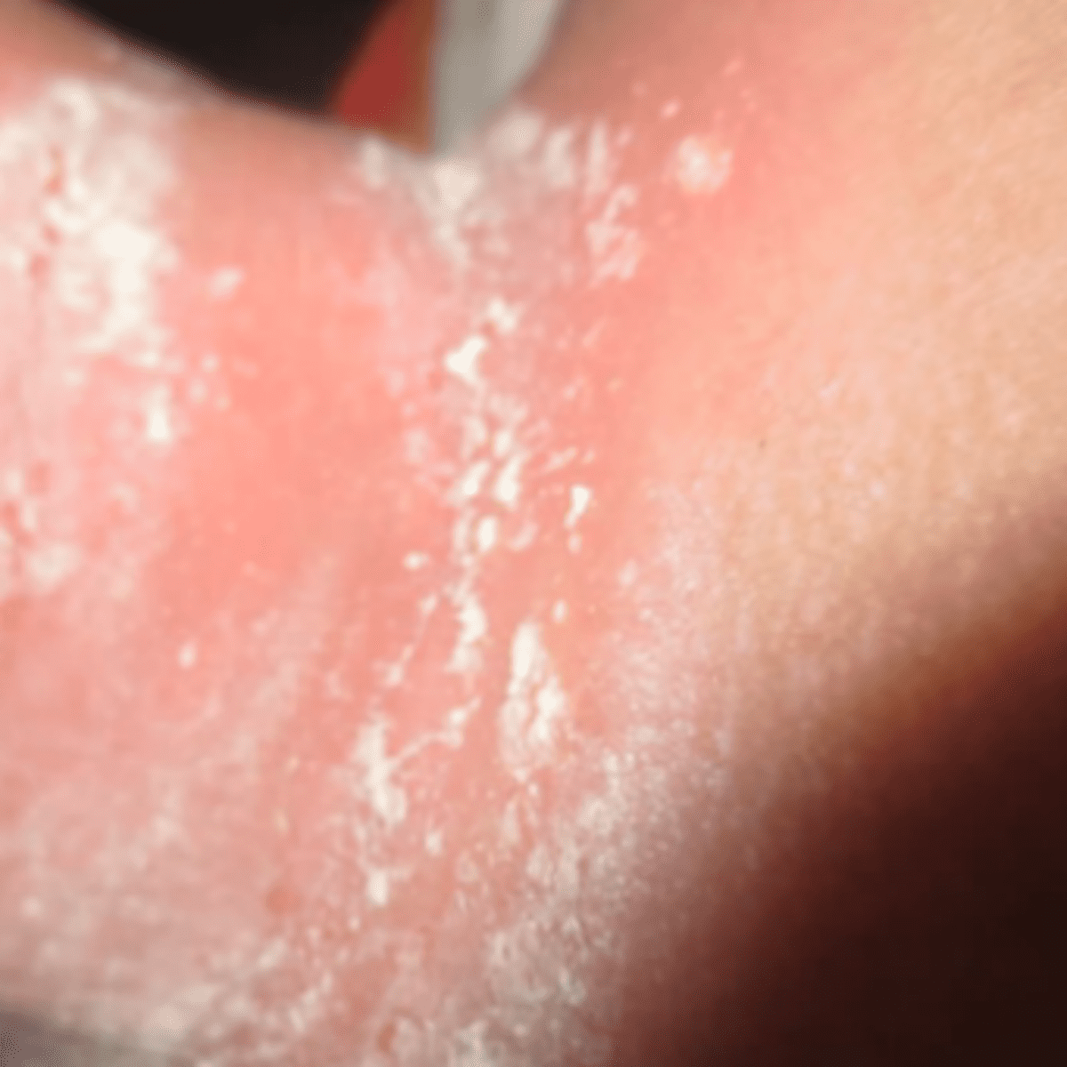Intertrigo rash under elderly woman's breast - Stock Image - M180/0082 -  Science Photo Library