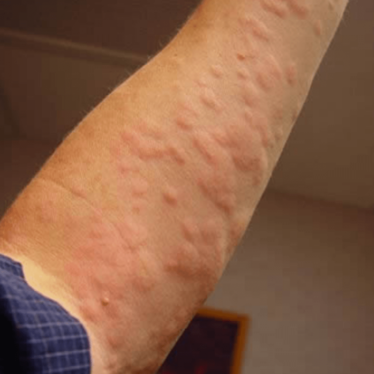 Relief From Hives Urticaria And Eczema Rashes In Under One Minute Naturally Hubpages
