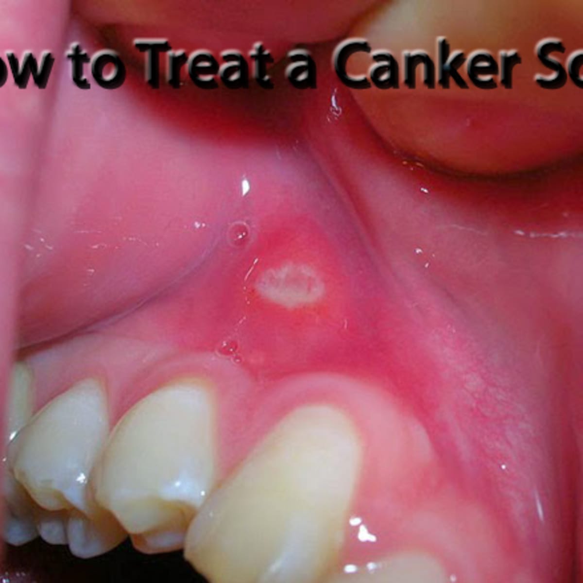 How To Relieve Mouth Sores - Treatmentstop21