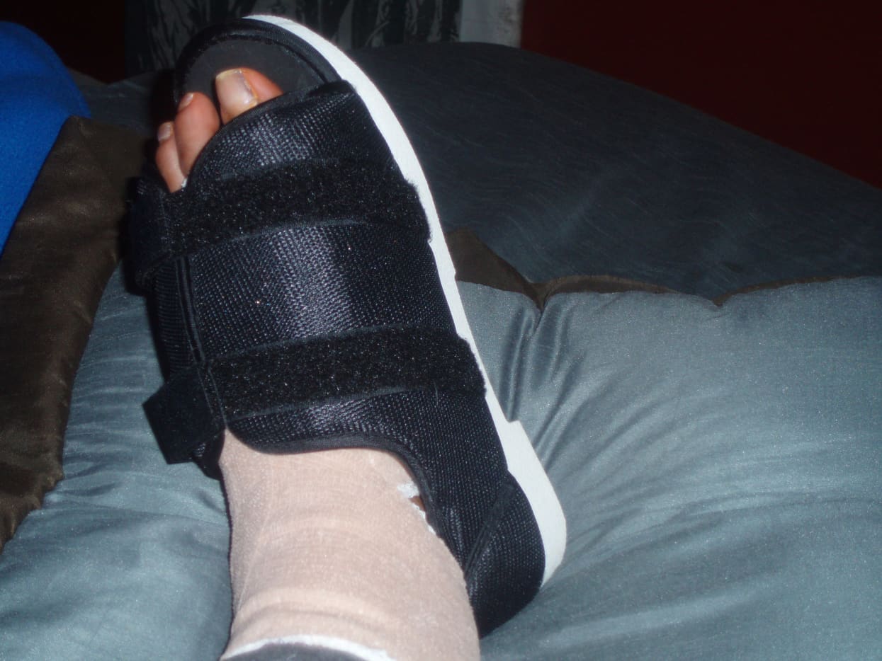 After My Foot (Bunion) Surgery HubPages