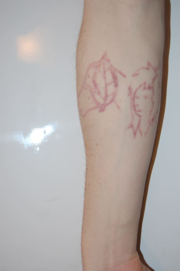 My Experience With Surgical Excision and Laser Tattoo ...