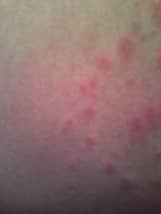 Pityriasis Rosea: My Strange Full-Body Rash - HubPages