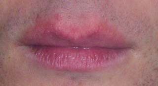 How to Care for Dry, Cracked, Chapped Lips - HubPages