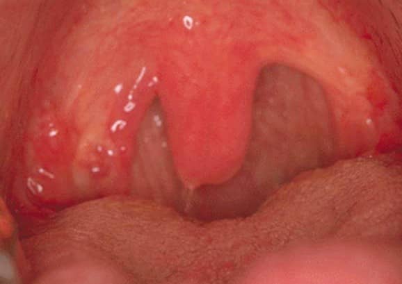 Swollen uvula pictures