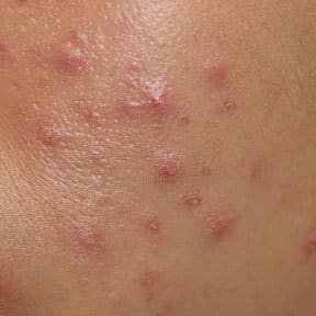 Pimples may appear alone or as an outbreak and are filled with white pus. Pimple sink deeper into the skin than herpes blisters.