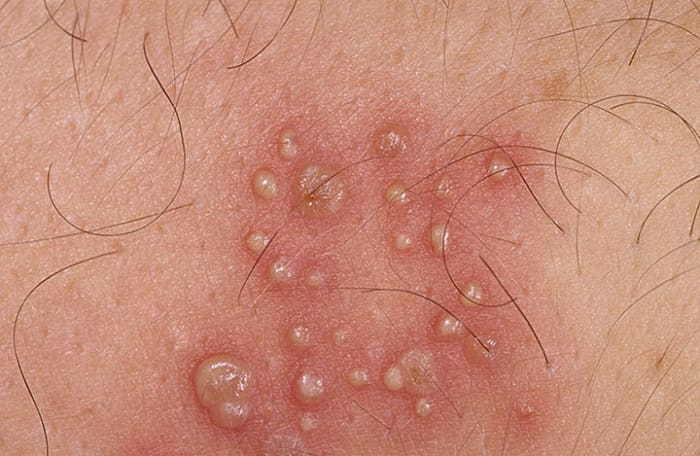 Herpes blisters are clear, white, or yellow and are filled with clear liquid. They lie right on the surface of the skin.