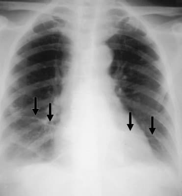 Radiologic studies of pulmonary embolisms