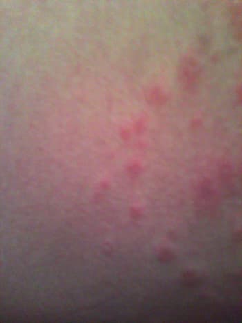 Here is itchy Pityriasis rosea hanging out on my right thigh.