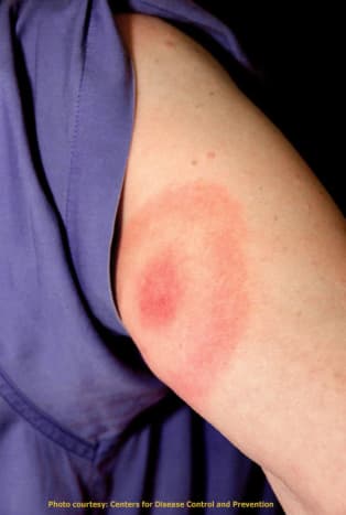 Typical EM rash caused by Lyme disease. Lyme rashes can disappear quickly, so if you don't know what kind of rash it is, it is wise to take a picture to document it for your doctor.