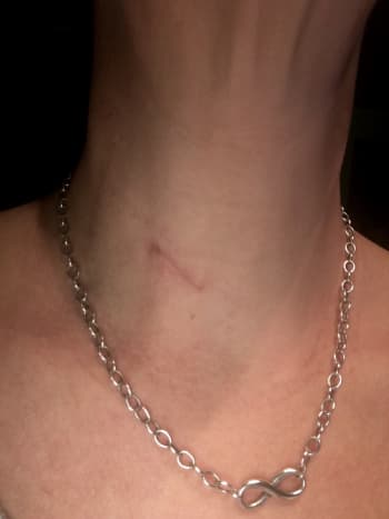 My scar four months post-op