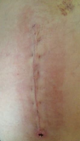 8-inch incision scar at 2 weeks (note bruising and swelling)