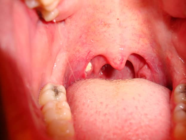 A pair of tonsils with a tonsillolith in the left side.