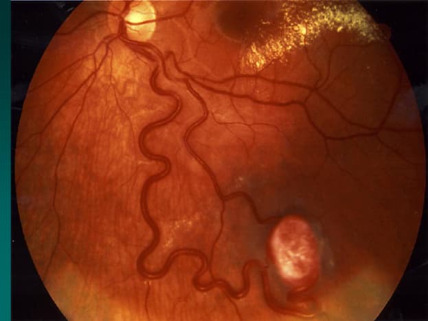 A VHL tumor of the eye