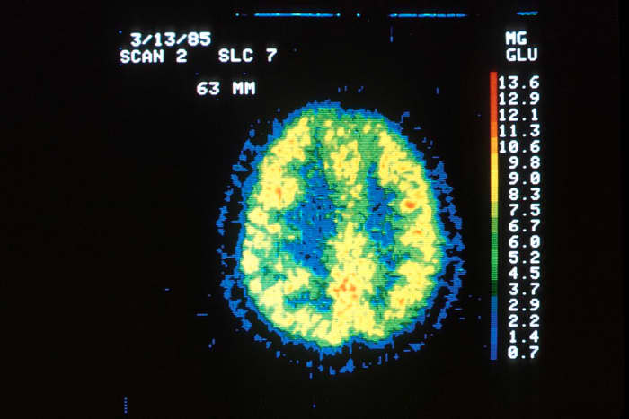 Position emission tomography (PET) of cerebral glucose utilization in a normal individual.  The gray matter appears yellow-red and the white matter is green-blue and uses less glucose.