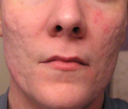 A man over the age of 40 with deep acne scars.
