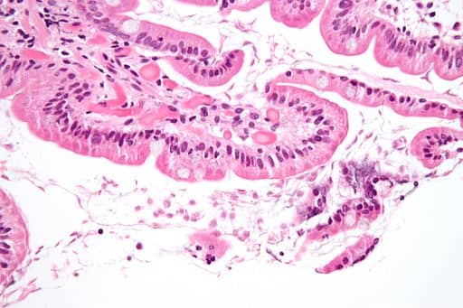 A flagellate is a type of protozoa. High magnification micrograph of a small bowel mucosa (duodenum) biopsy with giardiasis. H&amp;E stain. Giardiasis is due to the flagellate protozoan 