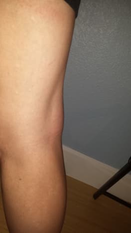 Baker's cyst in the back of my knee