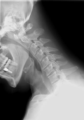 X-ray of cervical spine (neck) in flexion (bending forward). The facet joints are well aligned. Bony spurring is narrowing the C5-6 neural foramina bilaterally.