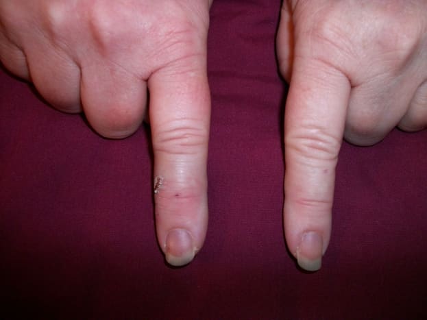 Injured index finger on left.  Circumference 5 mm greater at the base of the finger than the other index finger. Circumference 7 mm greater at the tip.  