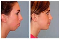 A receding chin is a good reason for an implant
