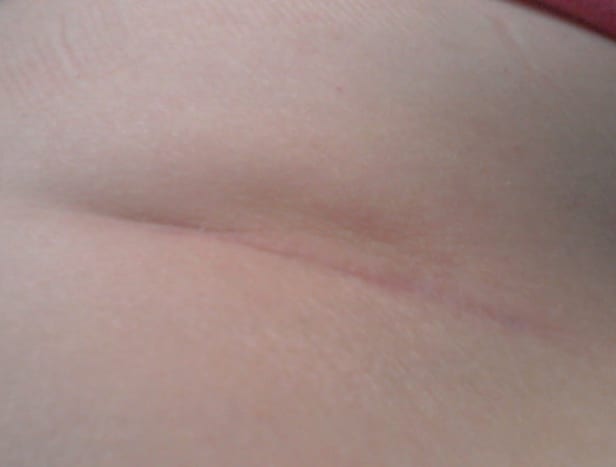 Main kidney removal scar approx 3.4 inches - above hip