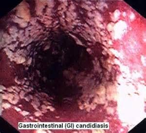 Candidiasis In The GI Tract