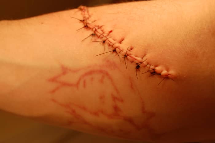 Right arm, one day after excision.