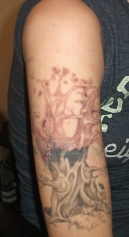 I've decided to laser off the entire tree! This is a few days after getting the laser. (Notice how faded the barbed wire is too! That is just from one session.)