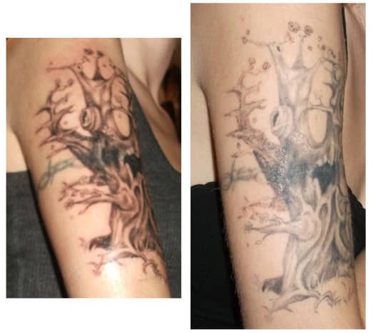 Before/after photos. Side-by-side comparison. The difference is awesome. On the left is the first day I got the tat, on the right is about 2+ months of constantly using my creams and doing laser treatment. 