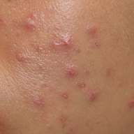 How to Tell the Difference Between Herpes and Pimples (With Photos ...